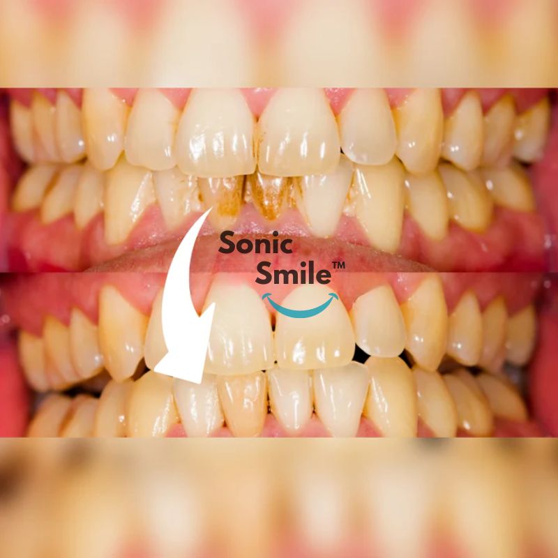 SonicSmile™ - Limpiador Dental Ultrasónico